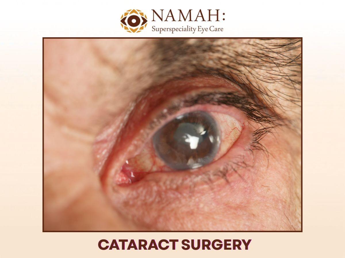 Cataract Surgery at Namah Superspeciality Eye Care, Pune